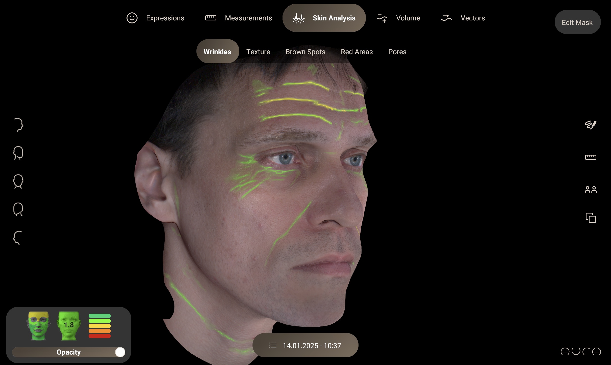 Análisis de las arrugas y su nivel de gravedad con Aura 3D Análisis de las arrugas y su nivel de gravedad